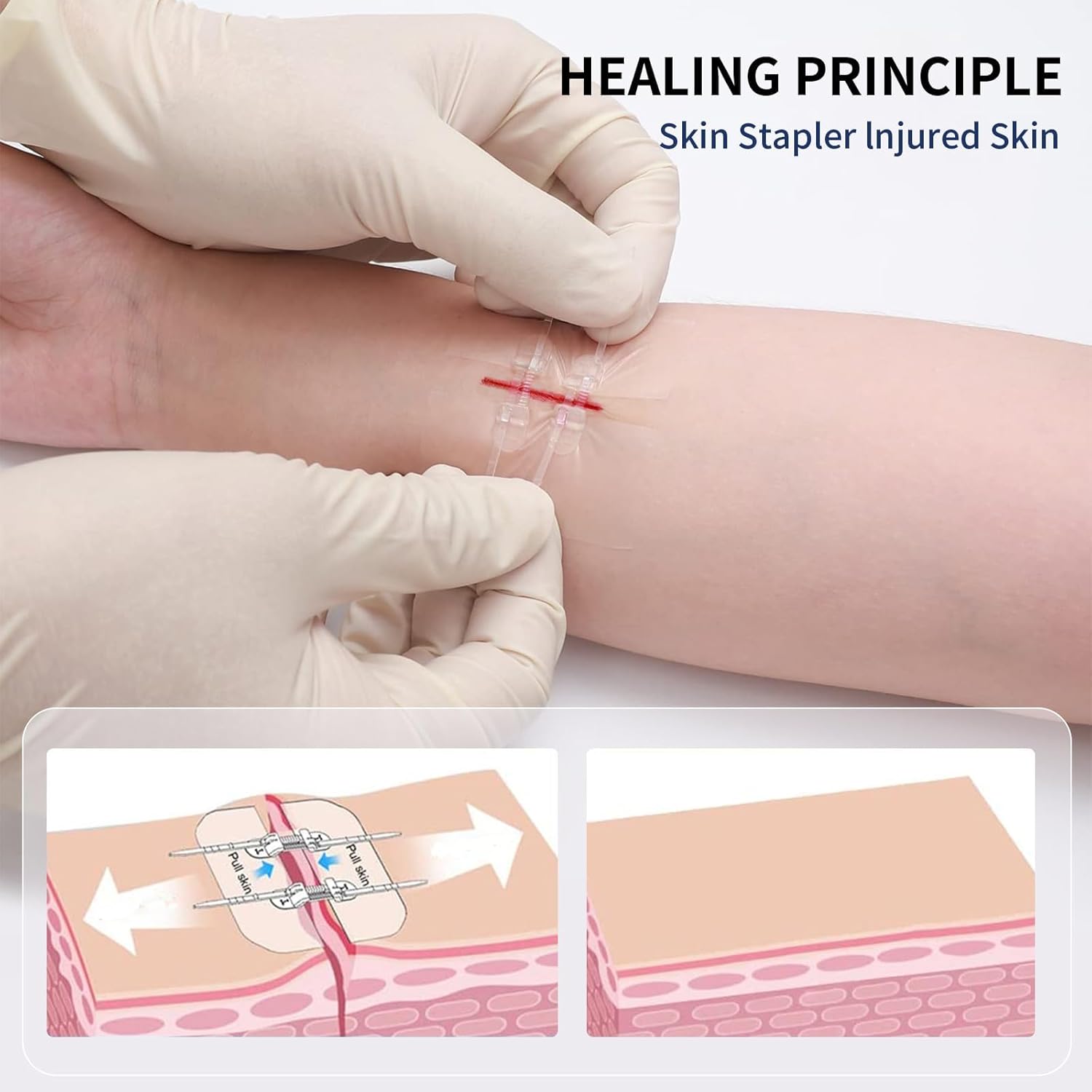 Zip Tie Suture Wound Closure Device – 7x6 cm Zipper Stitch Bandage for Emergency Cuts & Lacerations