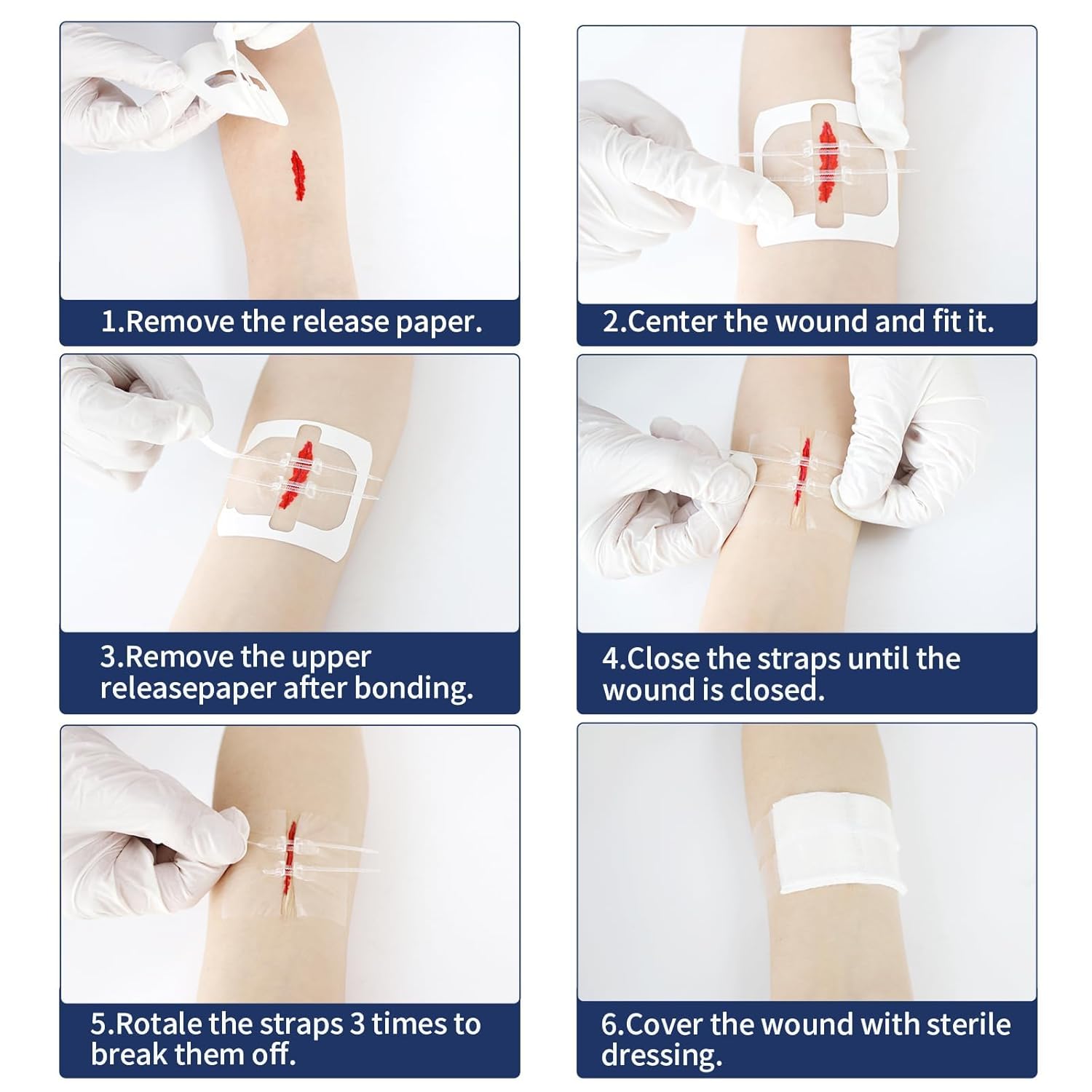 Zip Tie Suture Wound Closure Device – 7x6 cm Zipper Stitch Bandage for Emergency Cuts & Lacerations - Image 6